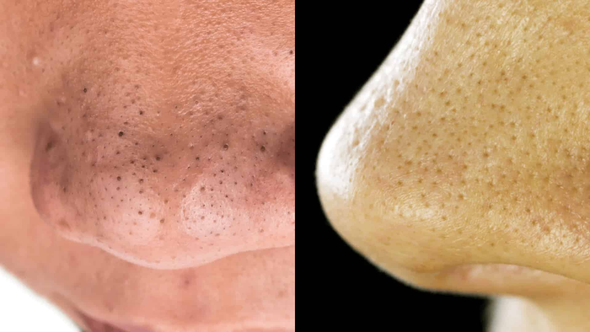 close-up side by side comparison showing blackheads and sebaceous filaments on nose and cheek skin