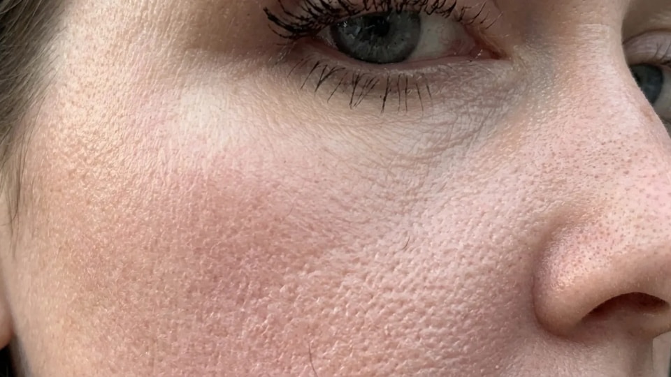 close up of textured facial skin with visible pores and uneven surface showing orange peel skin peau dorange effect