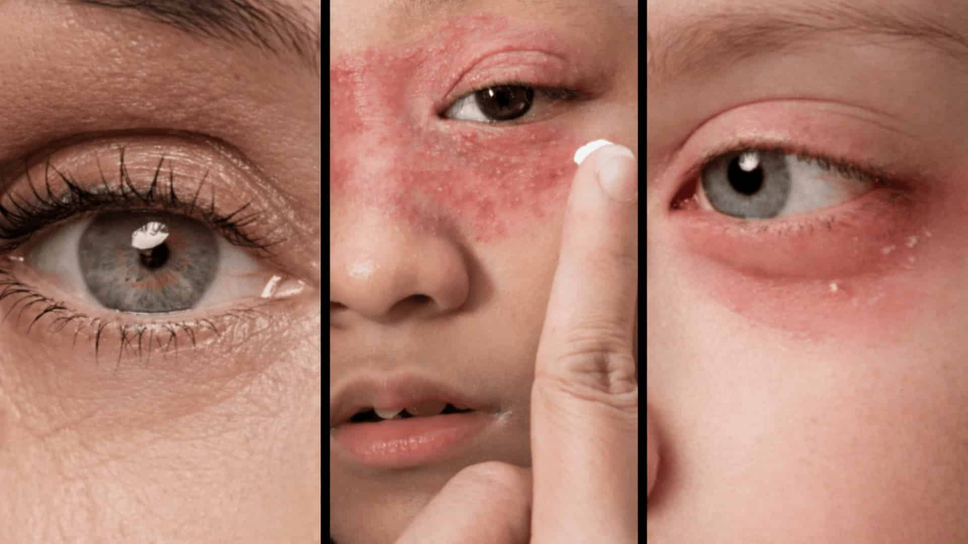 close-up of three eyes in panels divided by thin black lines, showing normal and irritated skin conditions