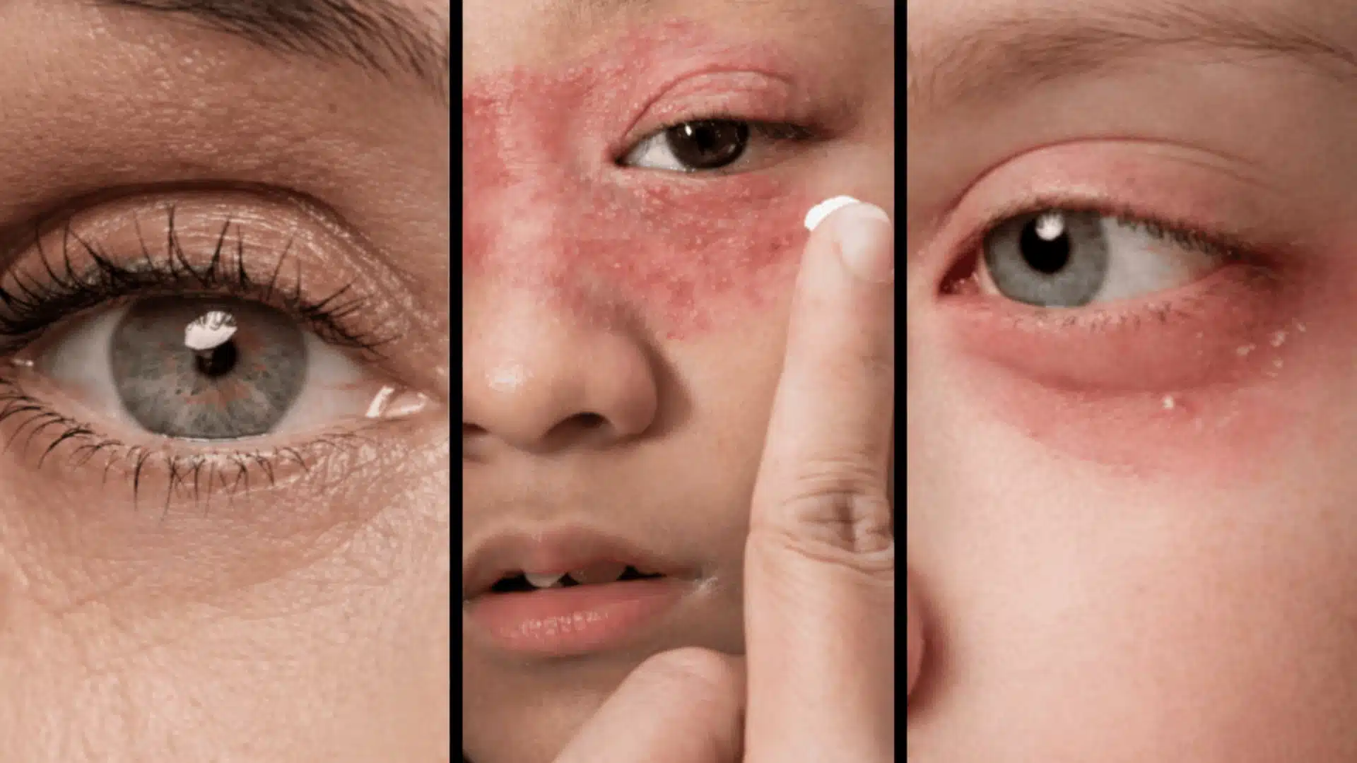 close-up of three eyes in panels divided by thin black lines, showing normal and irritated skin conditions