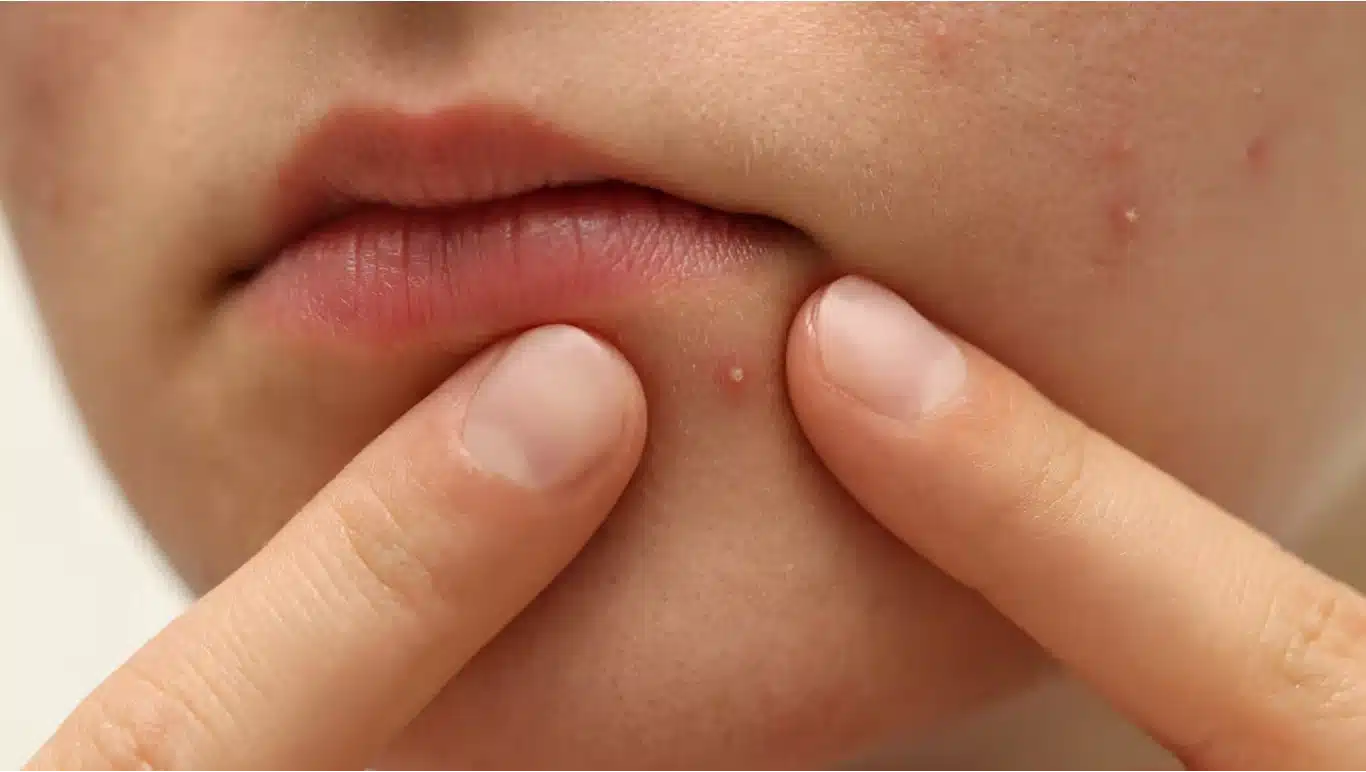 close-up cheek with red inflamed pimple surrounded by small whiteheads and natural skin texture detail