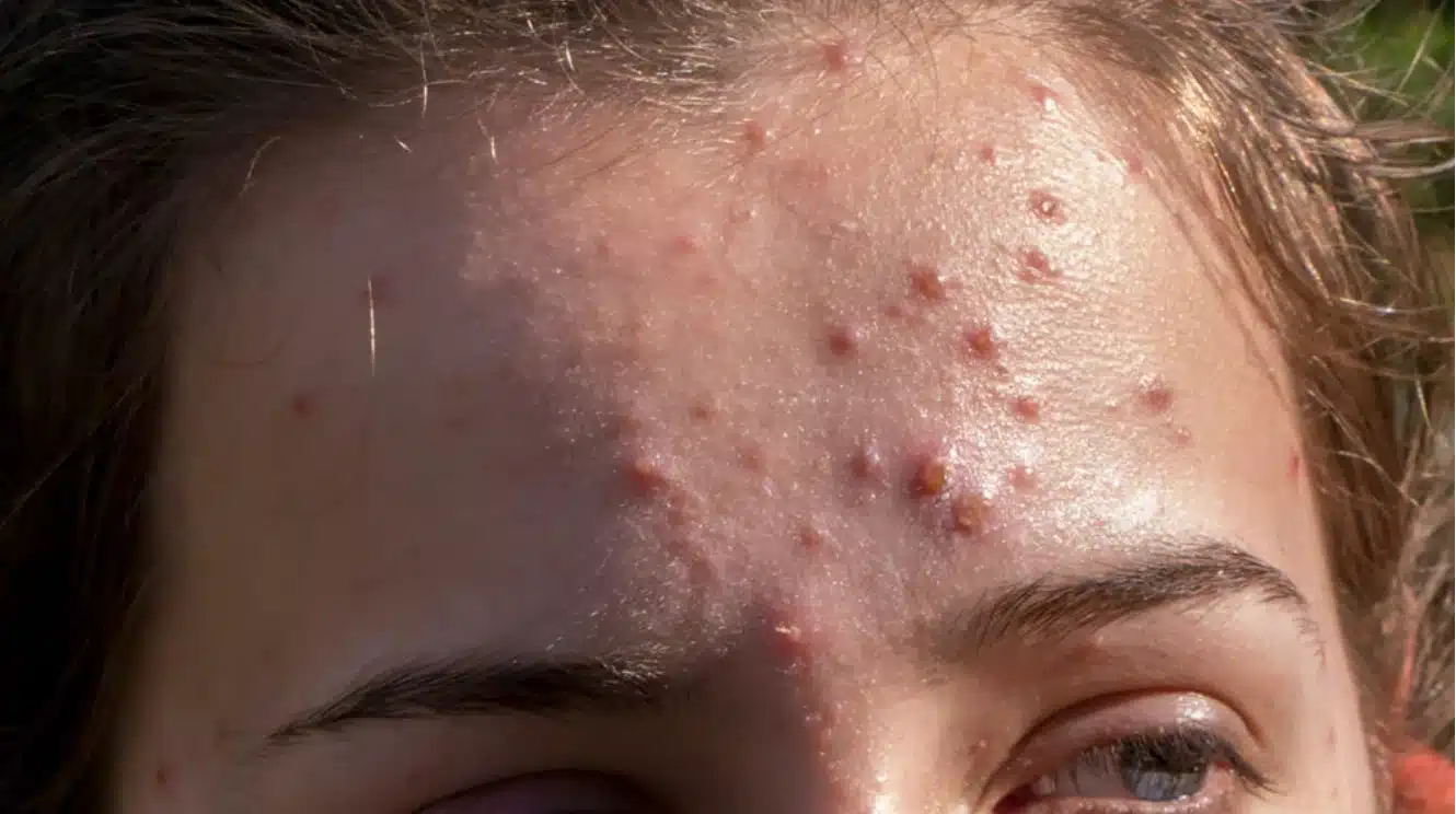 close-up of forehead with multiple inflamed acne papules and pustules on skin under natural light