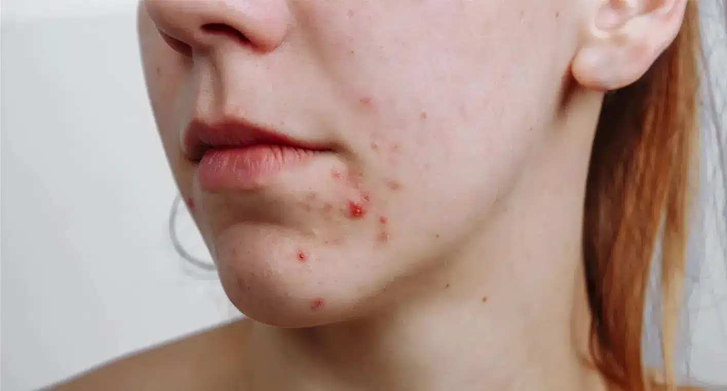 close-up of lower face showing red inflamed acne pimples on chin and jawline of a fair-skinned person