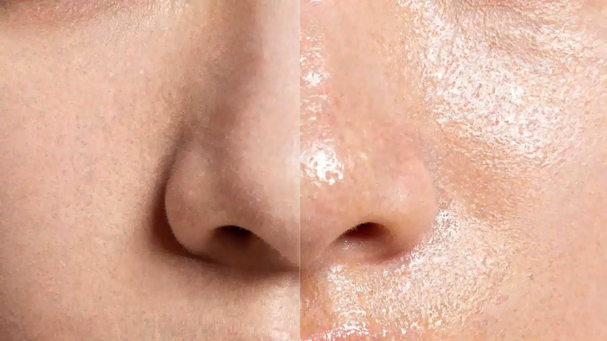 close-up comparison of normal and oily nose skin showing visible shine, pores, and natural skin texture on the t-zone