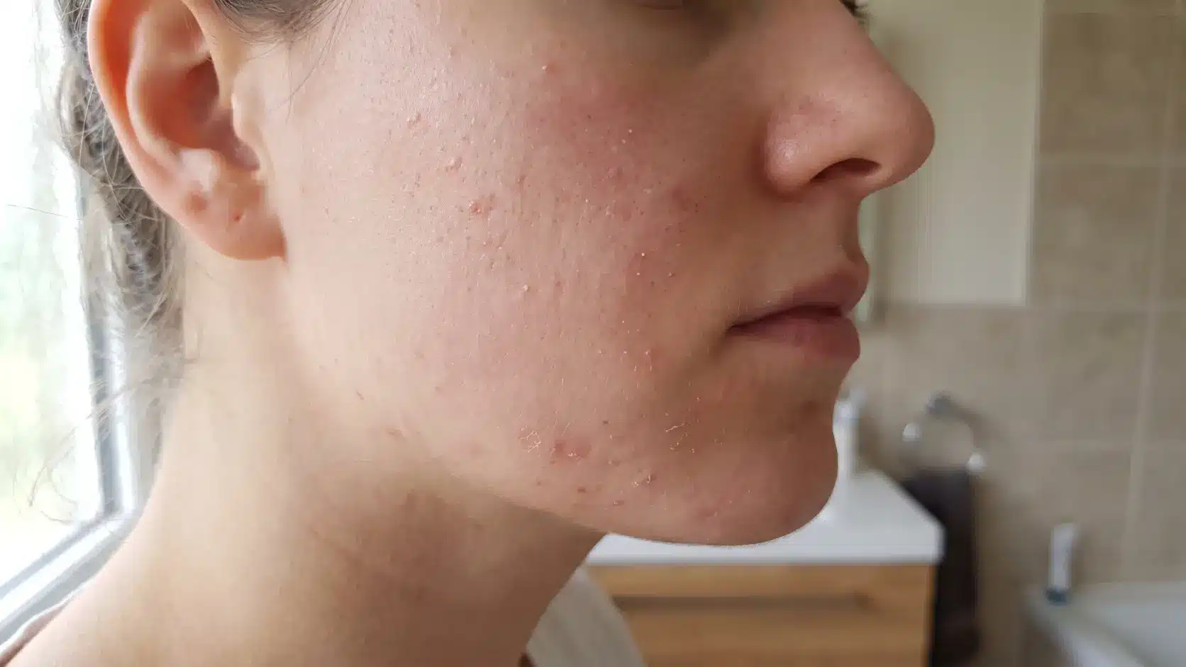 dry skin acne on cheek with flakes whiteheads and redness showing what dry breakouts can look like