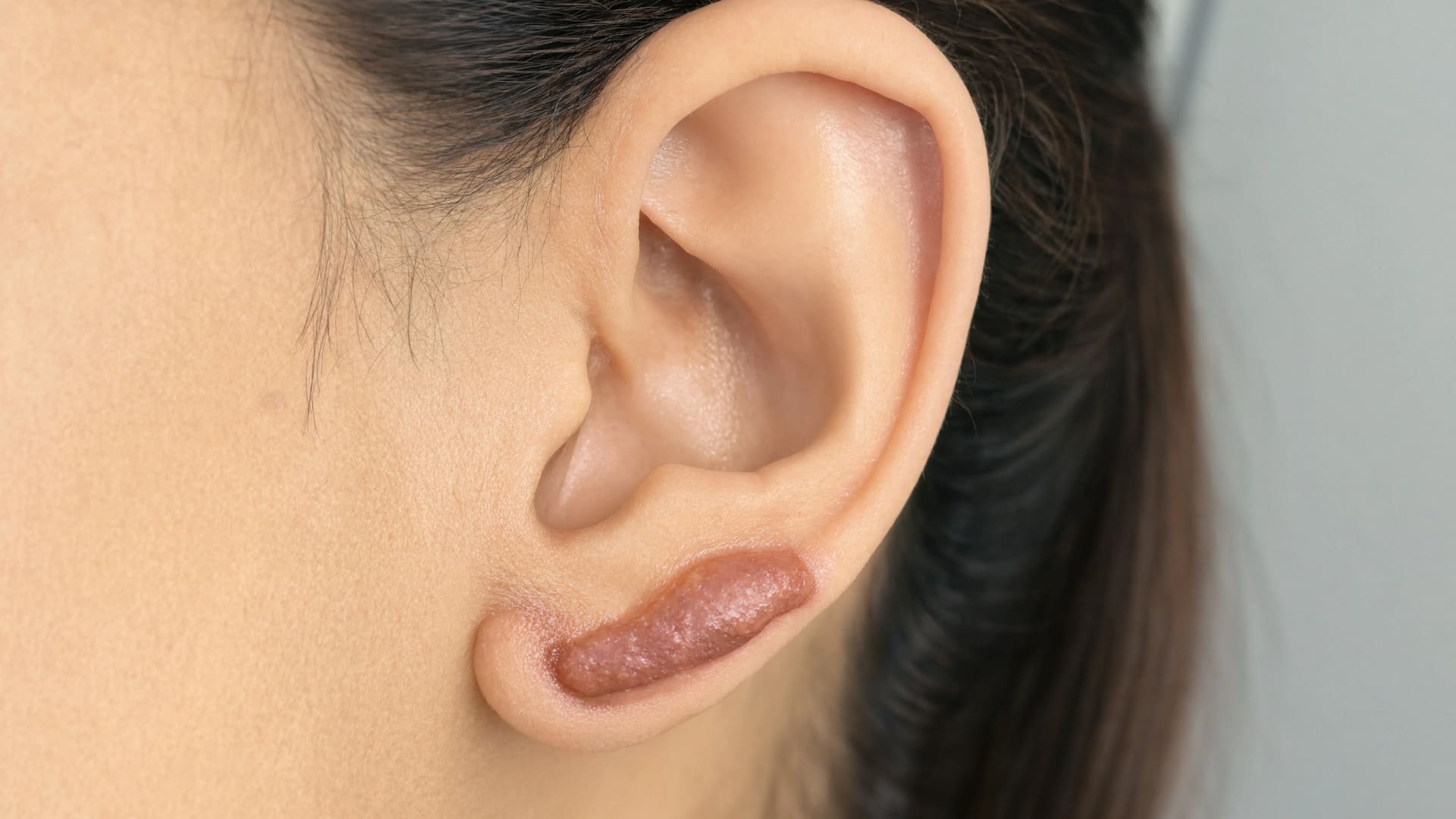 keloid scar around piercing showing firm overgrown tissue that extends beyond the original site