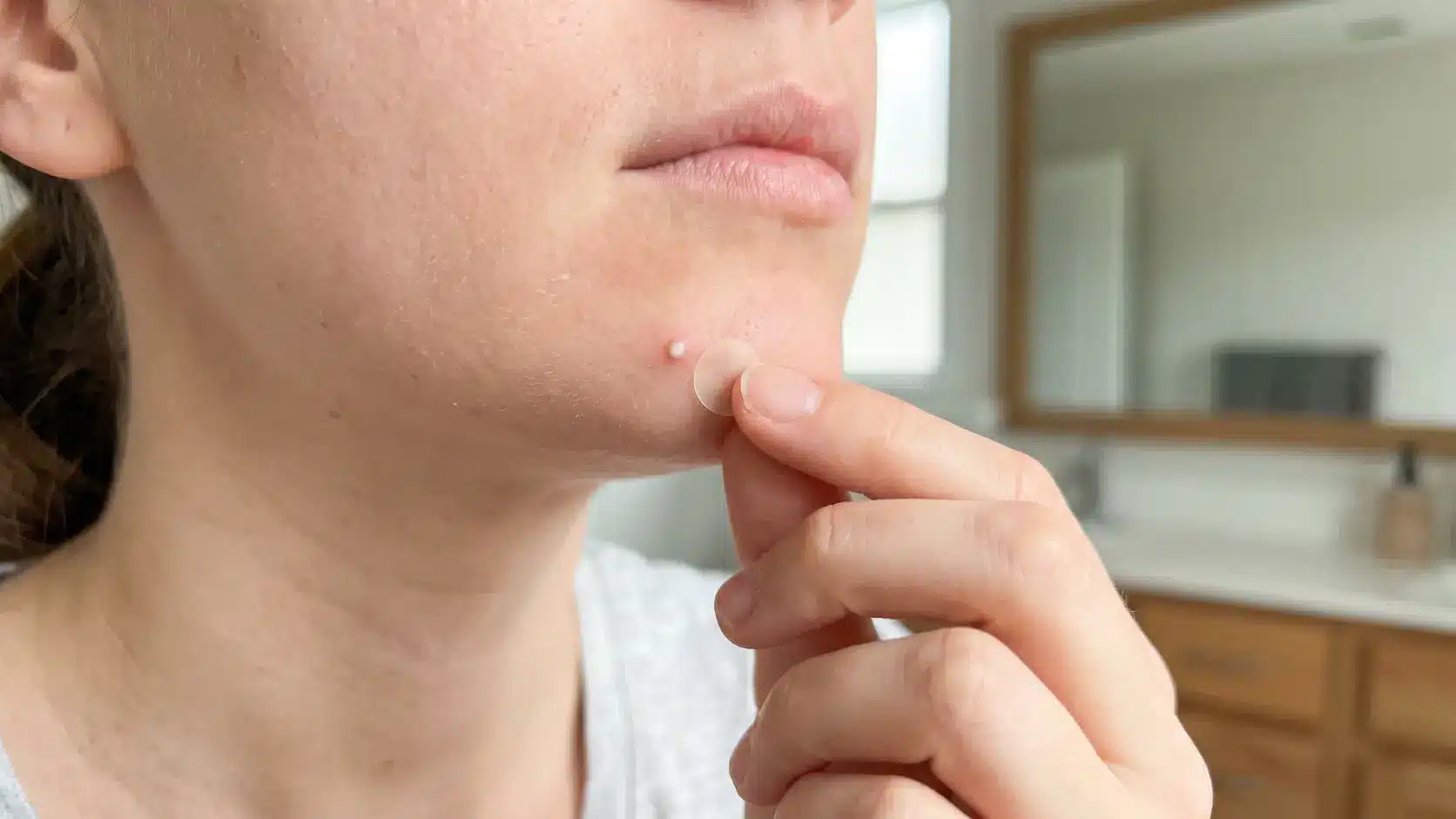 person applying pimple patch to whitehead with dry skin nearby for gentle active pimple care