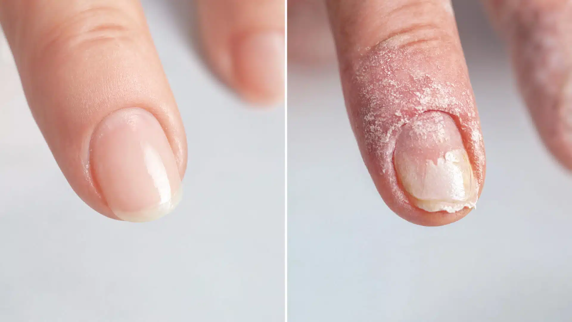 side-by-side view of healthy and unhealthy cuticles showing texture, color, and infection signs