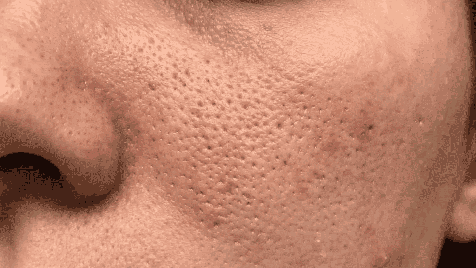 close up of cheek with enlarged pores and dimpled texture showing orange peel skin peau dorange appearance