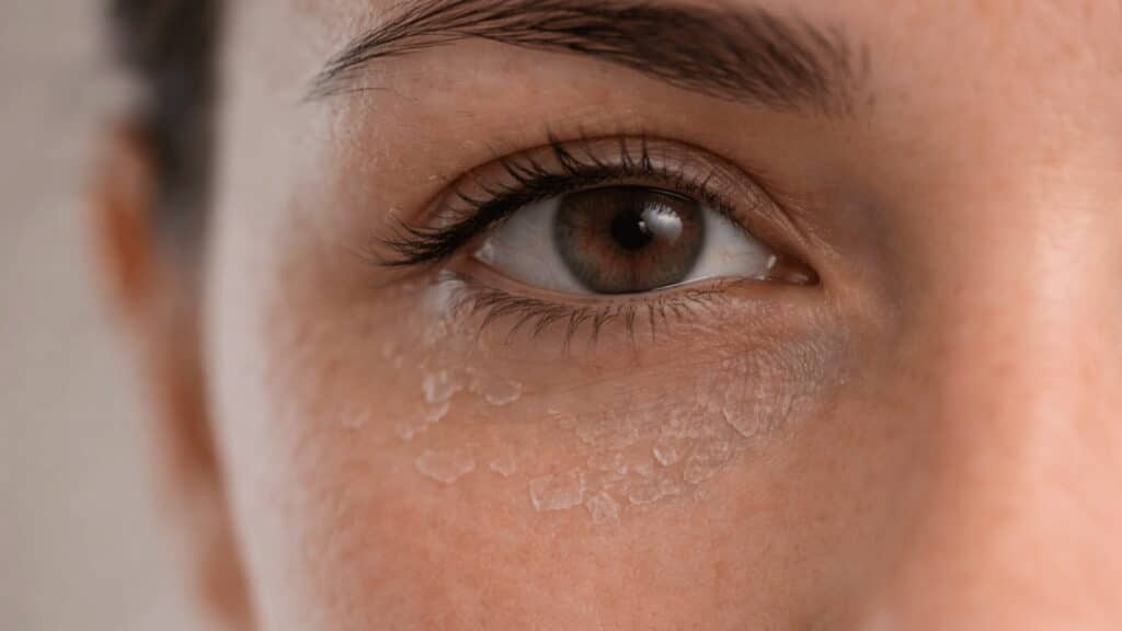 close up of one eye showing dry flaky skin and peeling under eye area with visible texture in soft natural light