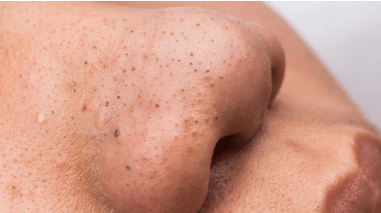macro close-up of nose showing single blackhead on skin surface with visible pores and natural skin texture in soft lighting (2)