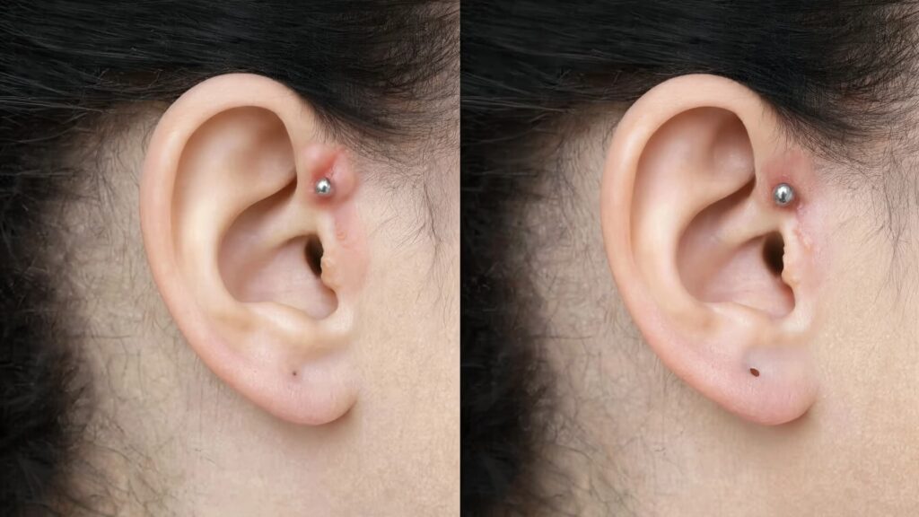 piercing bump vs keloid understanding irritation and scar growth differences on ear piercings
