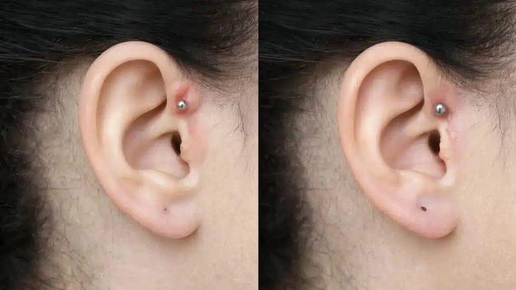 piercing bump vs keloid understanding irritation and scar growth differences on ear piercings