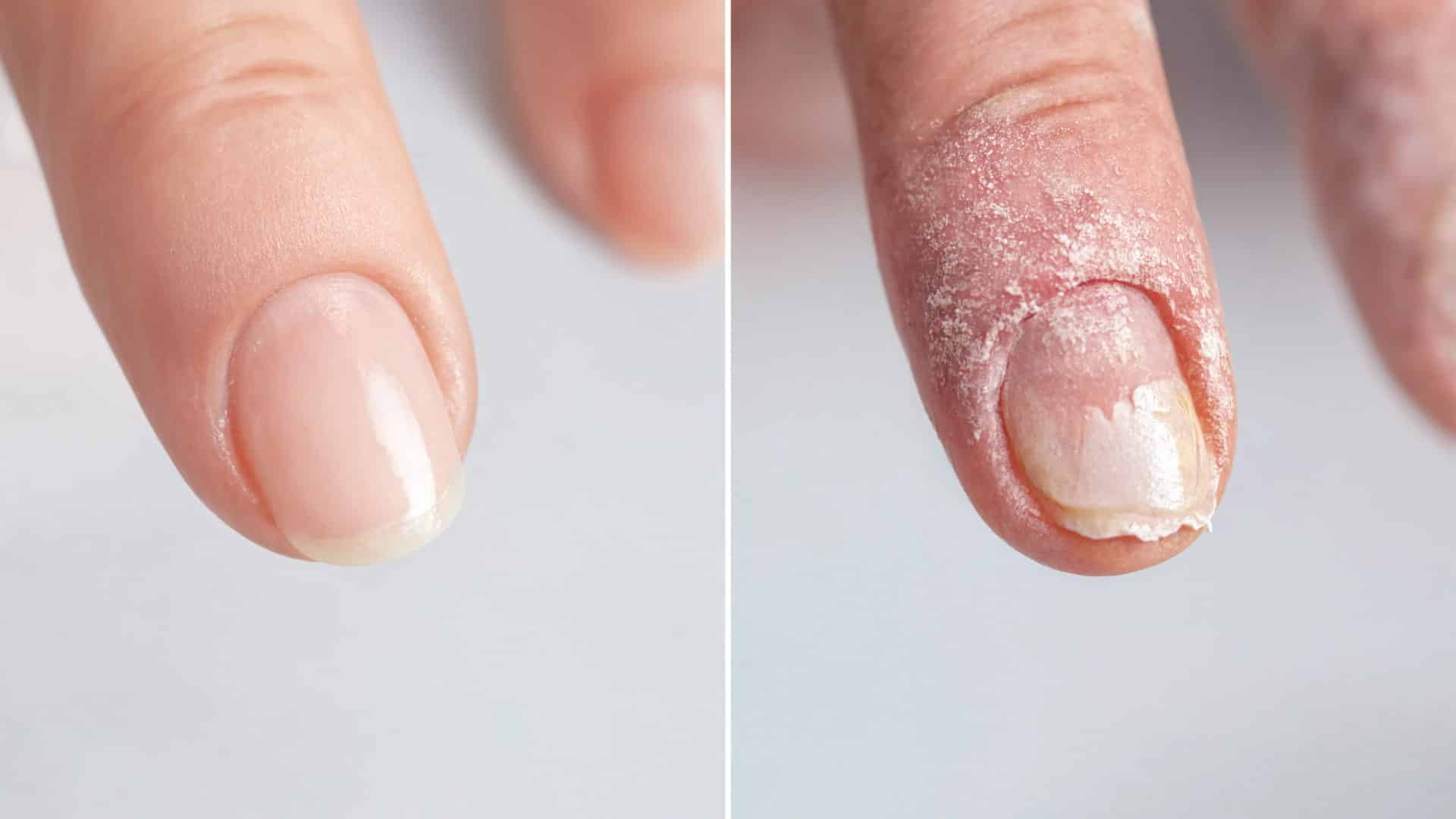 side-by-side view of healthy and unhealthy cuticles showing texture, color, and infection signs