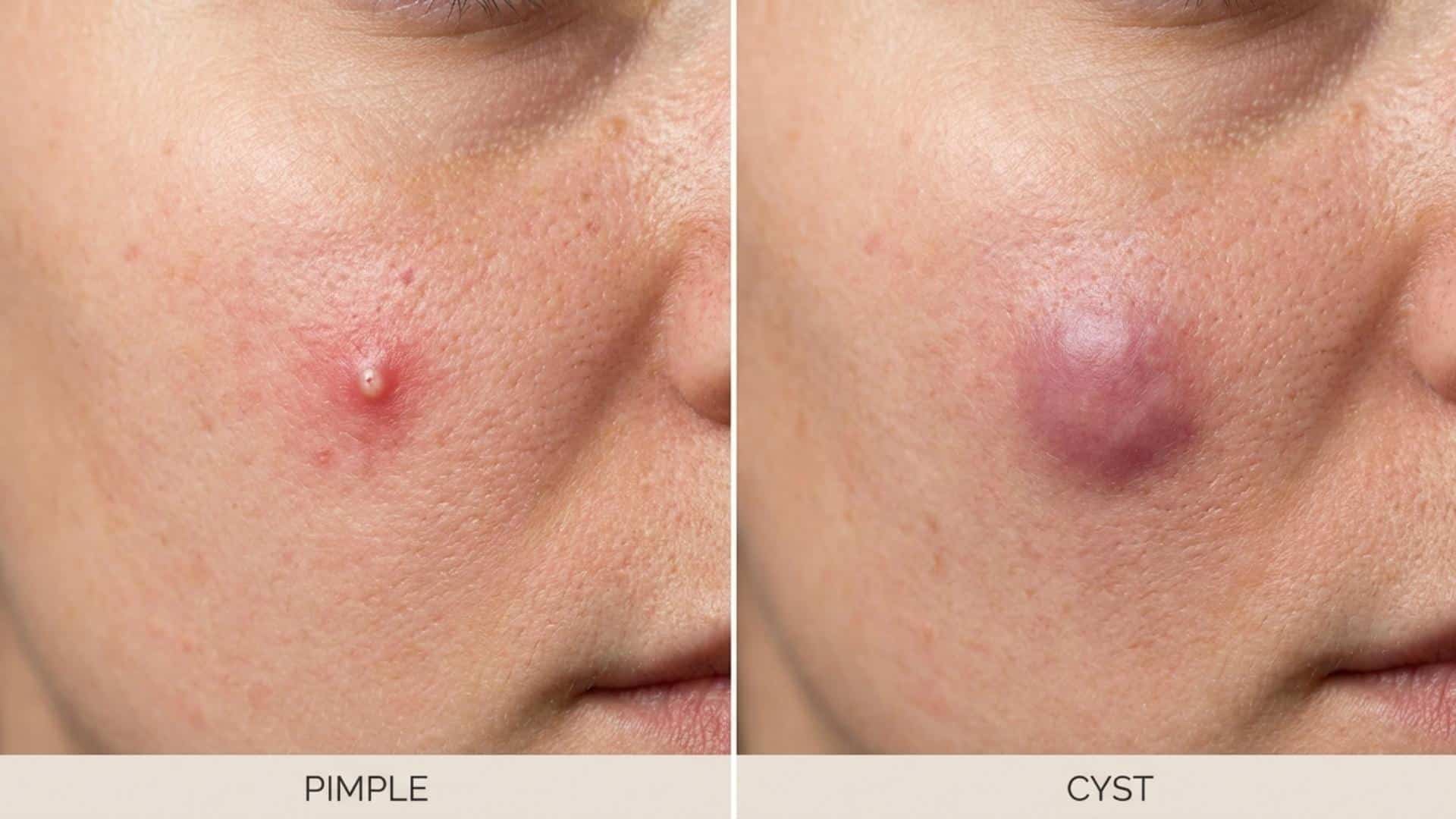 Pimple vs cyst comparison showing surface level acne bump with whitehead and deeper swollen cyst under skin texture
