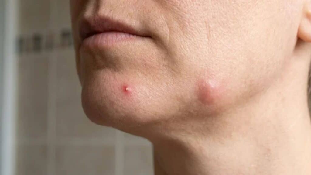 Pimple vs Cyst