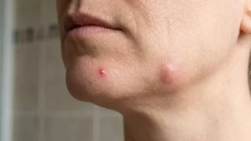 Pimple vs Cyst
