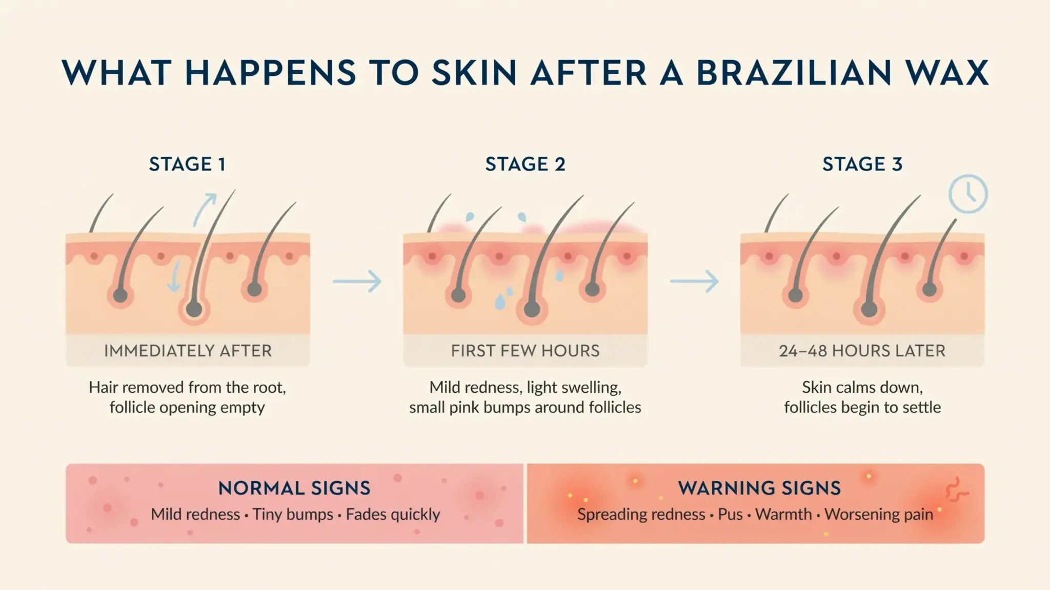Infographic showing three skin recovery stages after a Brazilian wax with normal reactions and warning symptoms