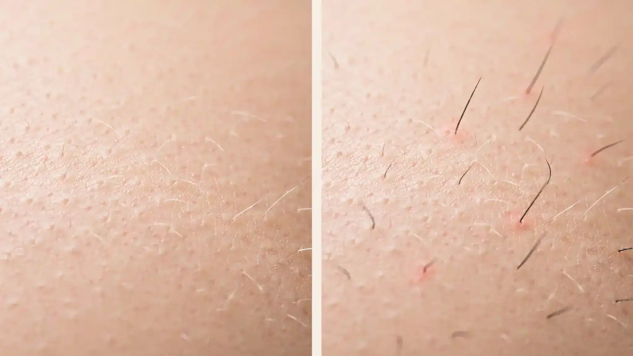Close-up illustration comparing peach fuzz and early stubble regrowth after a Brazilian wax on skin.