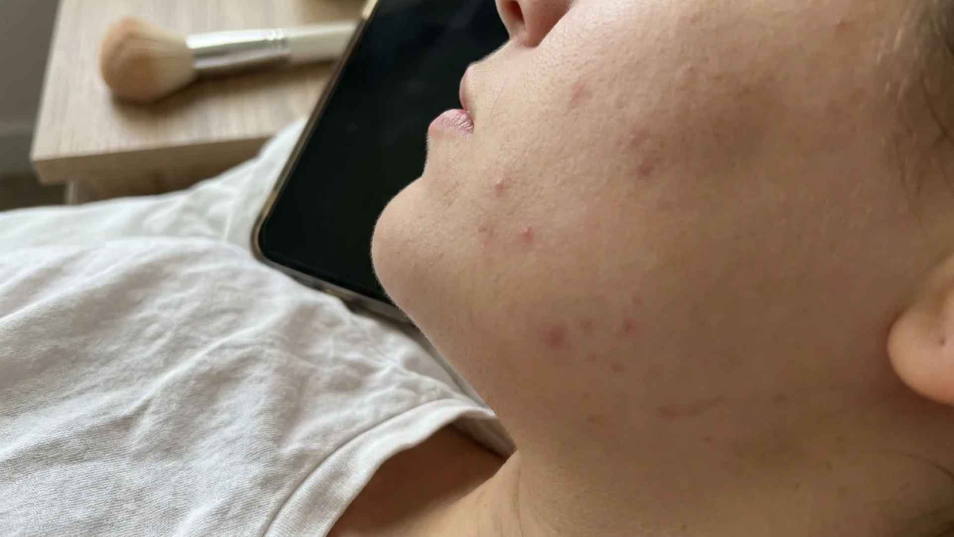 Close-up cheek acne showing breakouts linked to phone contact, dirty pillowcases, makeup brushes, and daily habits.