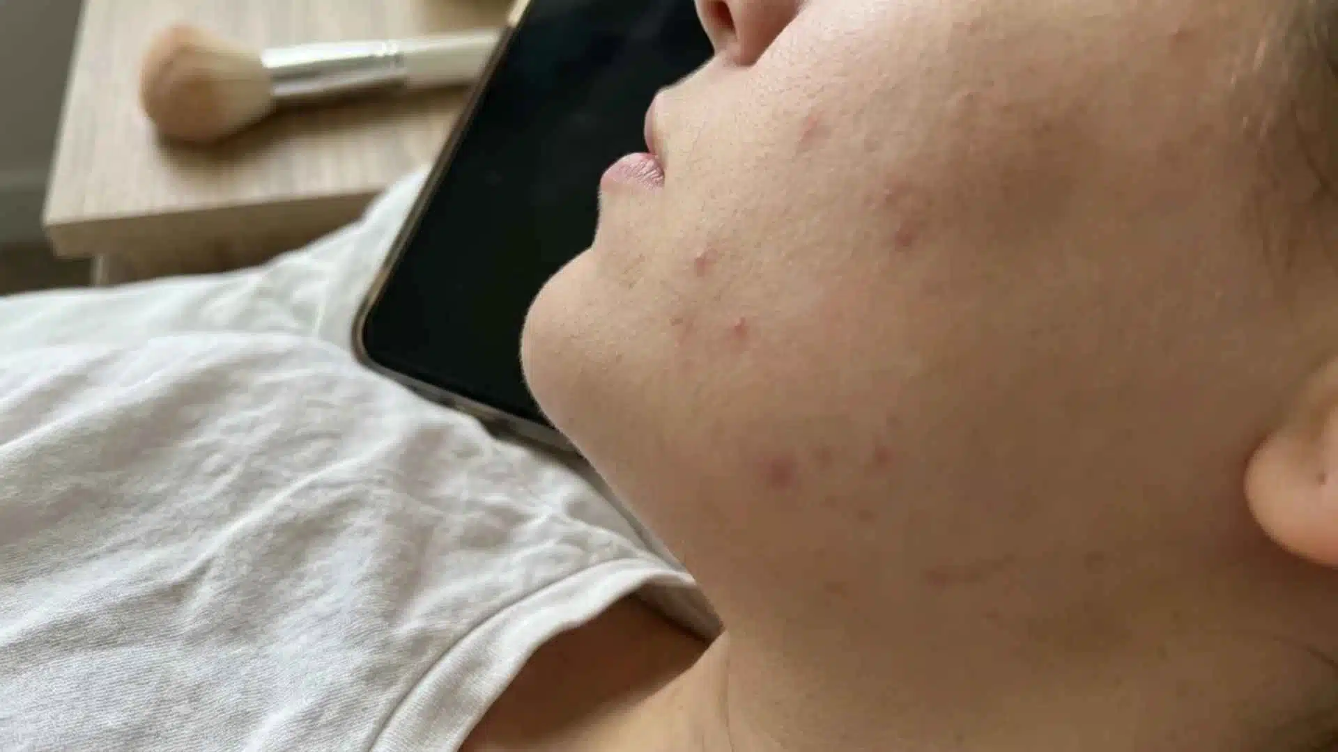 Close-up cheek acne showing breakouts linked to phone contact, dirty pillowcases, makeup brushes, and daily habits.