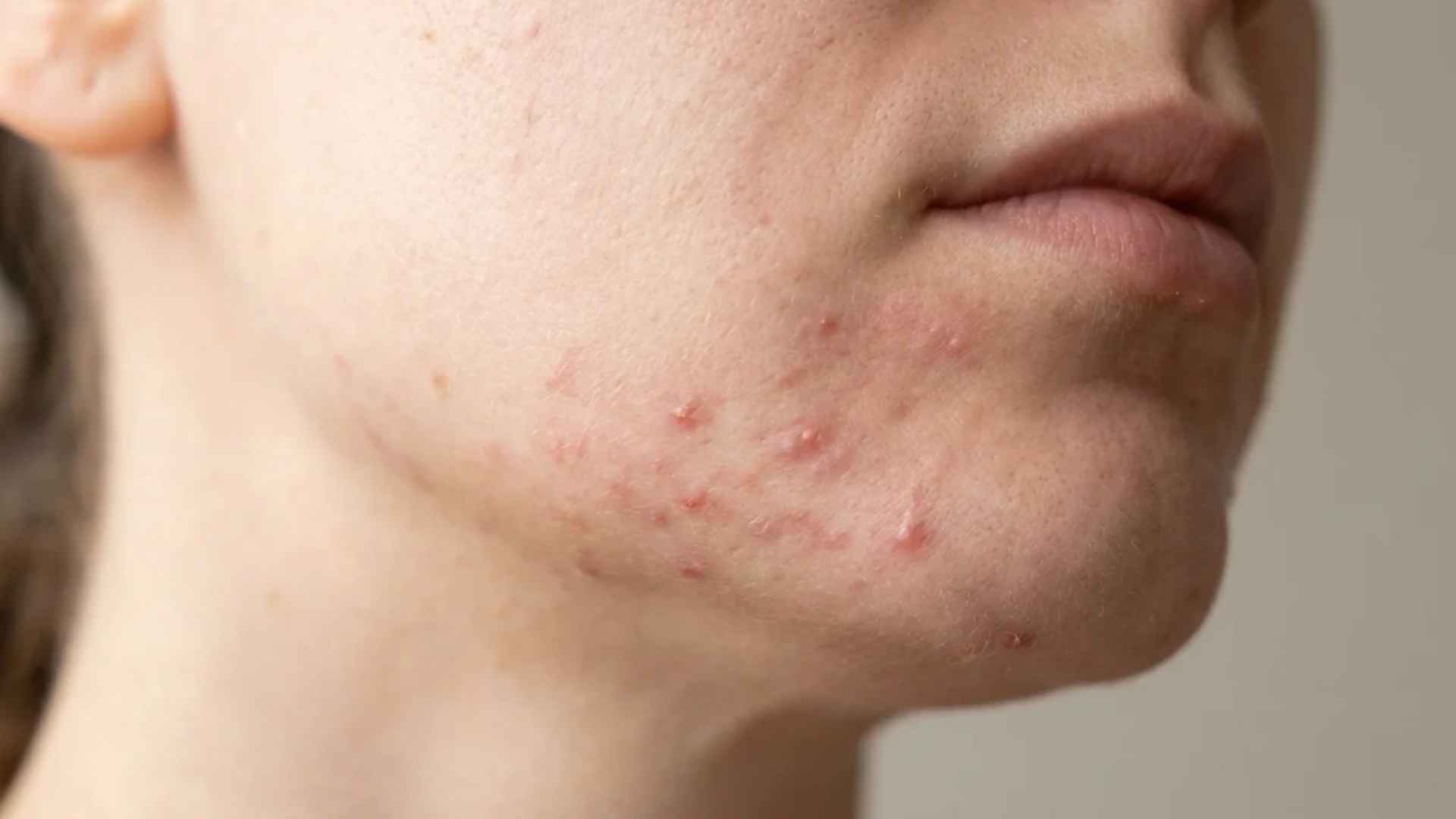 Close-up chin and jawline showing hormonal acne breakouts with redness and blemishes linked to common skin changes.