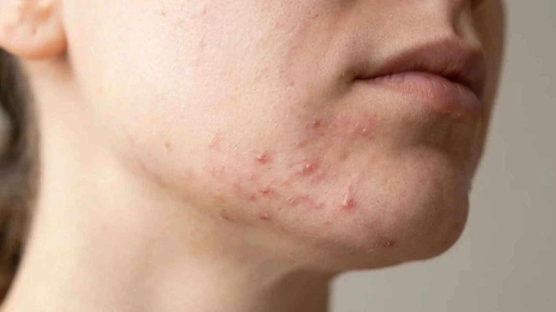Close-up chin and jawline showing hormonal acne breakouts with redness and blemishes linked to common skin changes.
