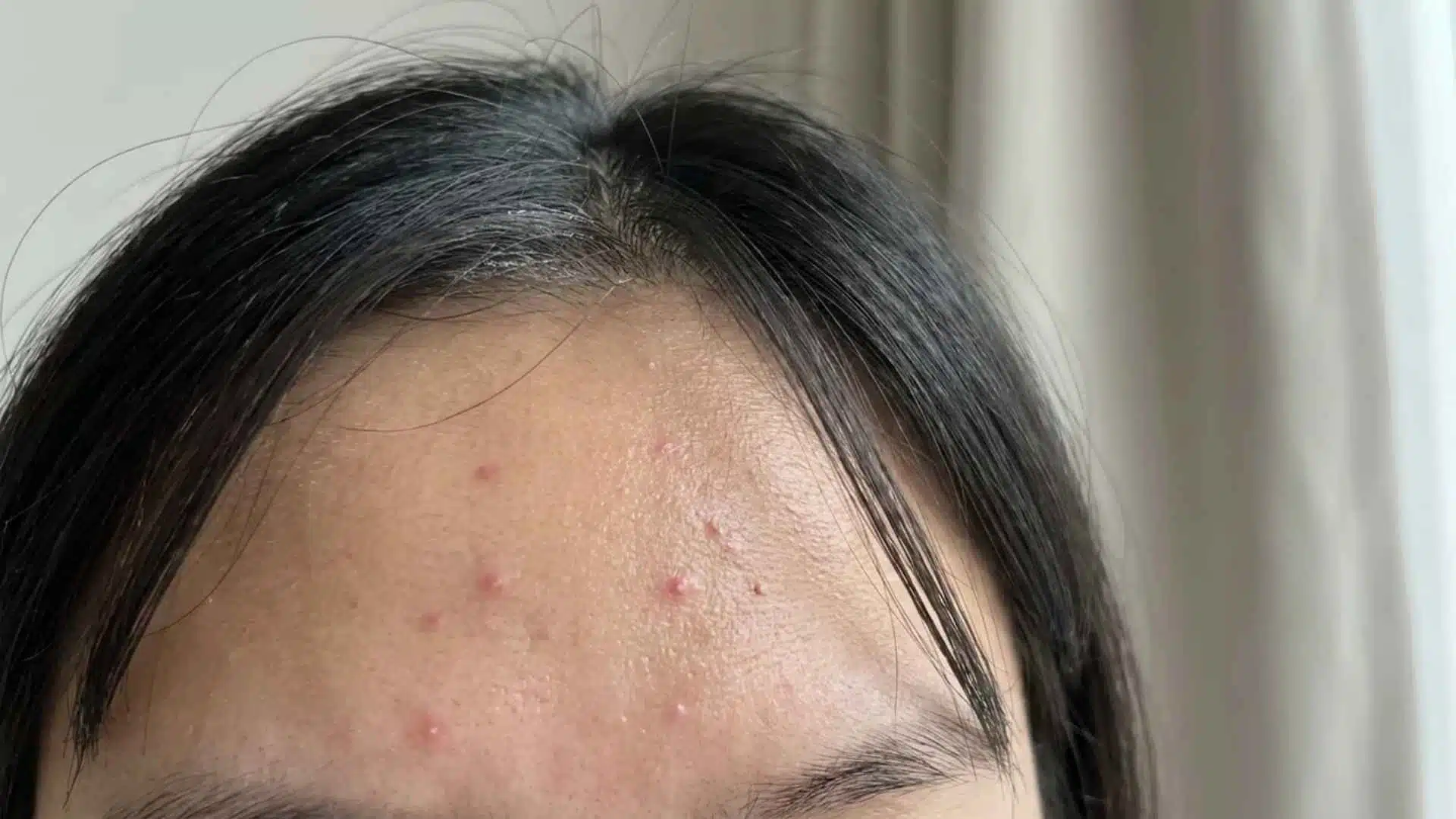 Close-up of forehead acne showing small breakouts in the T-zone linked to oil, hair products, and clogged pores.