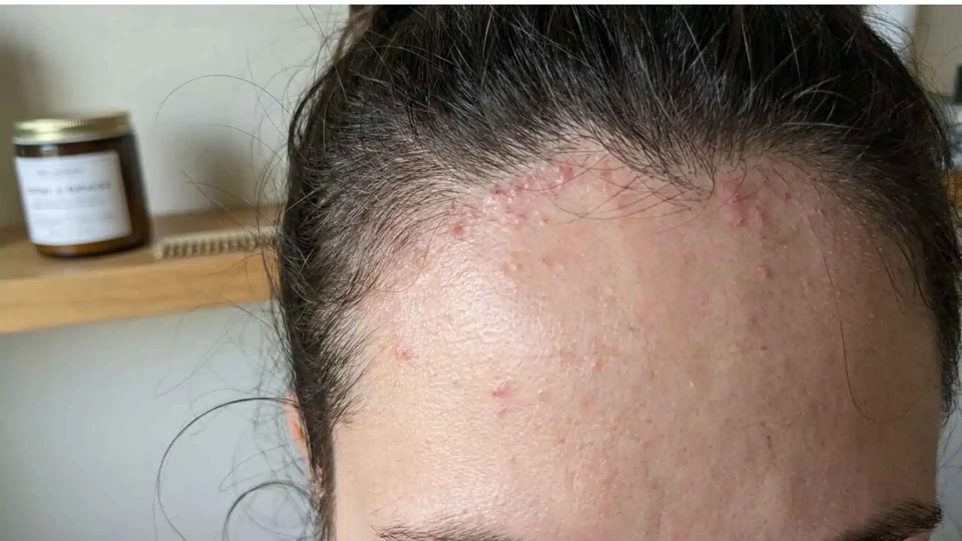 Close-up hairline acne showing small bumps caused by hair products, oil buildup, and clogged pores near the forehead.
