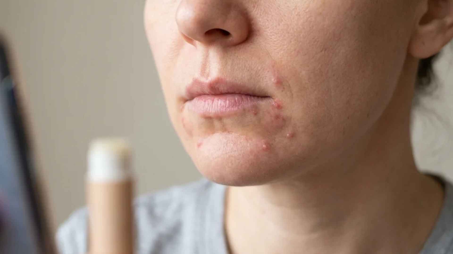 Close-up mouth area showing small acne breakouts linked to lip products, phone contact, toothpaste, and daily irritation triggers.