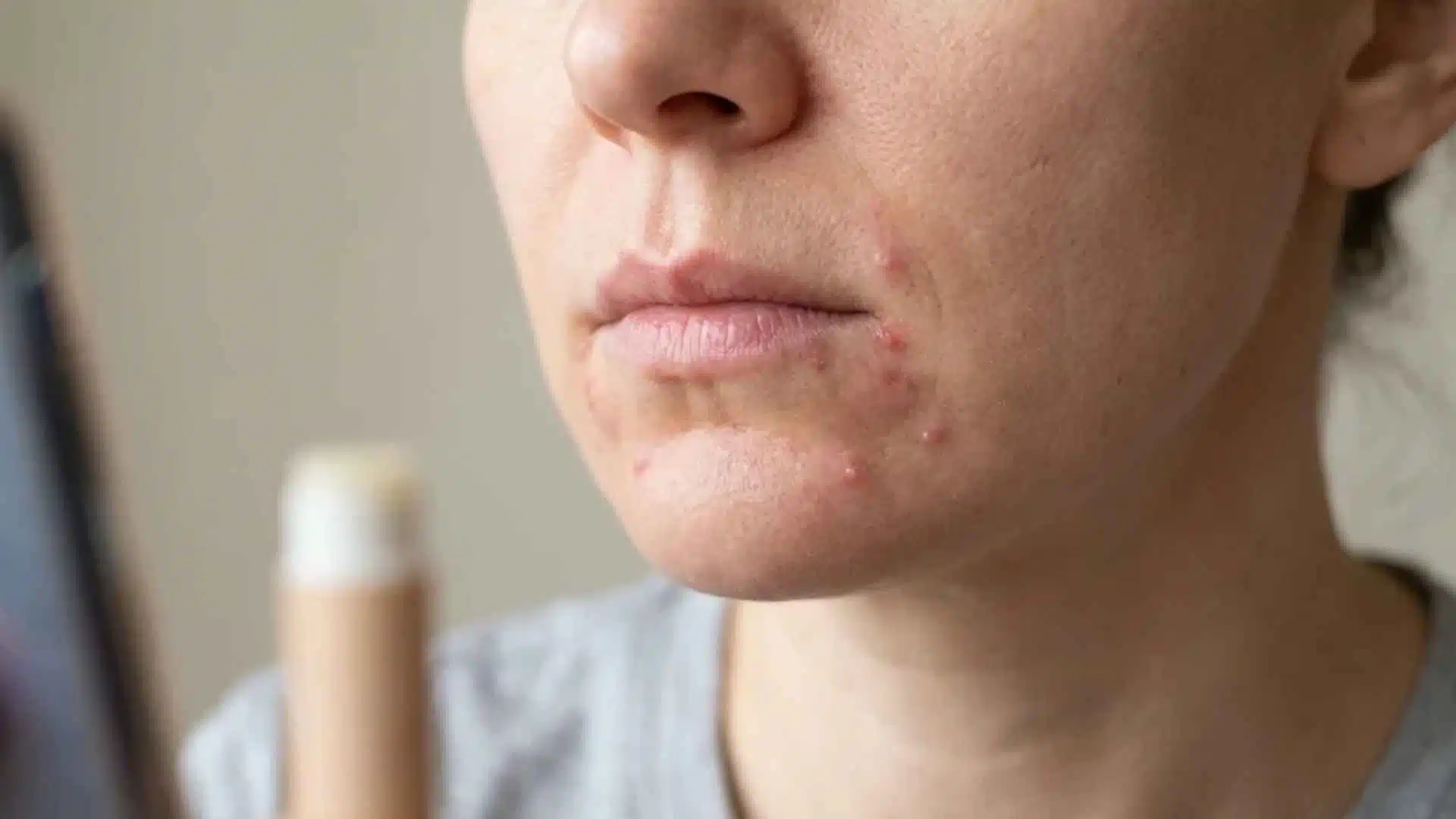 Close-up mouth area showing small acne breakouts linked to lip products, phone contact, toothpaste, and daily irritation triggers.