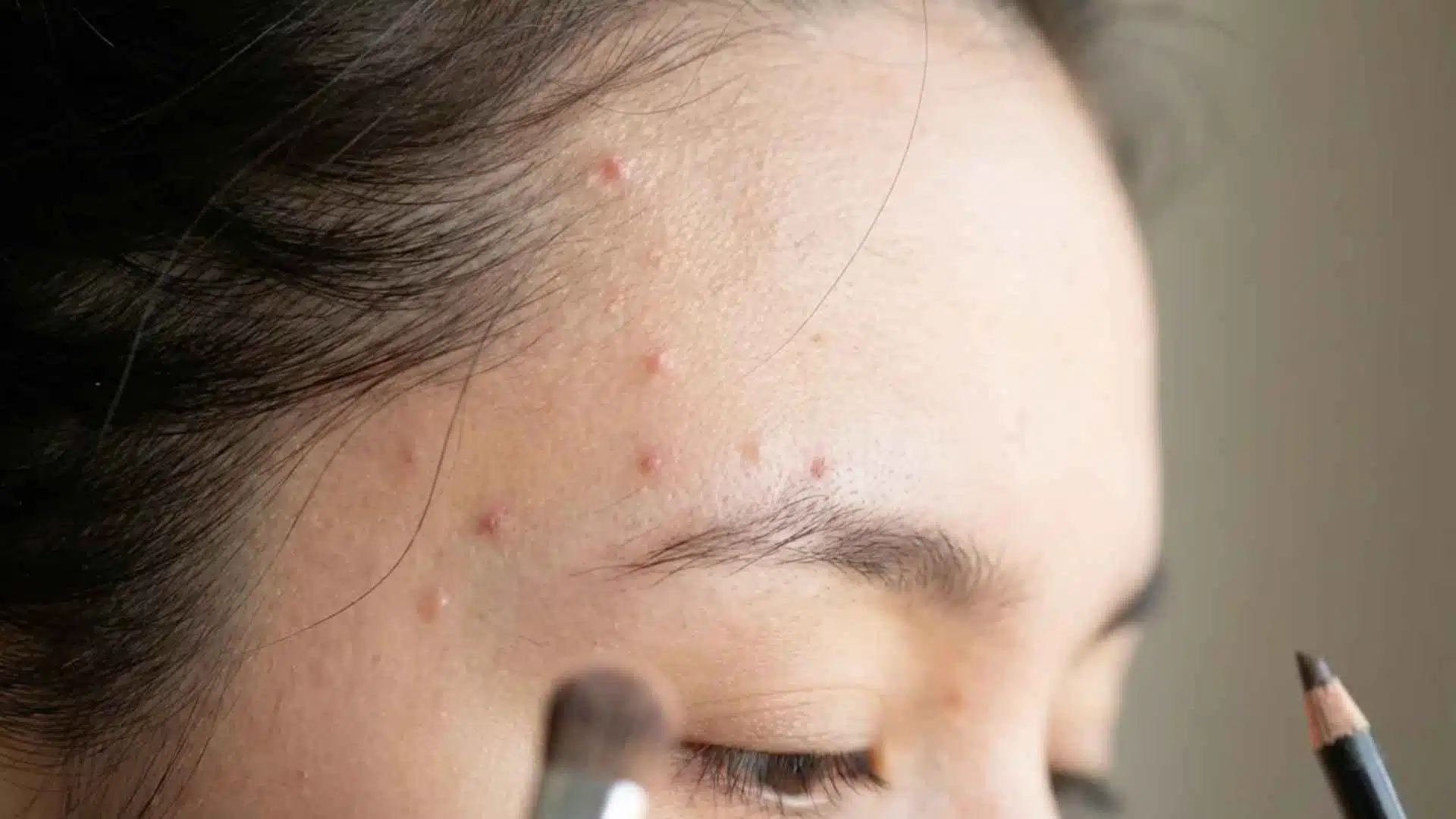 Close-up temple and eyebrow acne showing small breakouts linked to makeup tools, hair products, and sweat buildup.